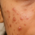 Acne, Breakouts & Congested Skin