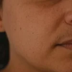 Before After - Uneven Skin
